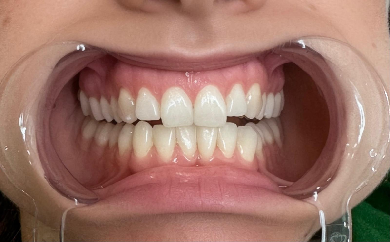 Cosmetic Teeth Whitening Treatment