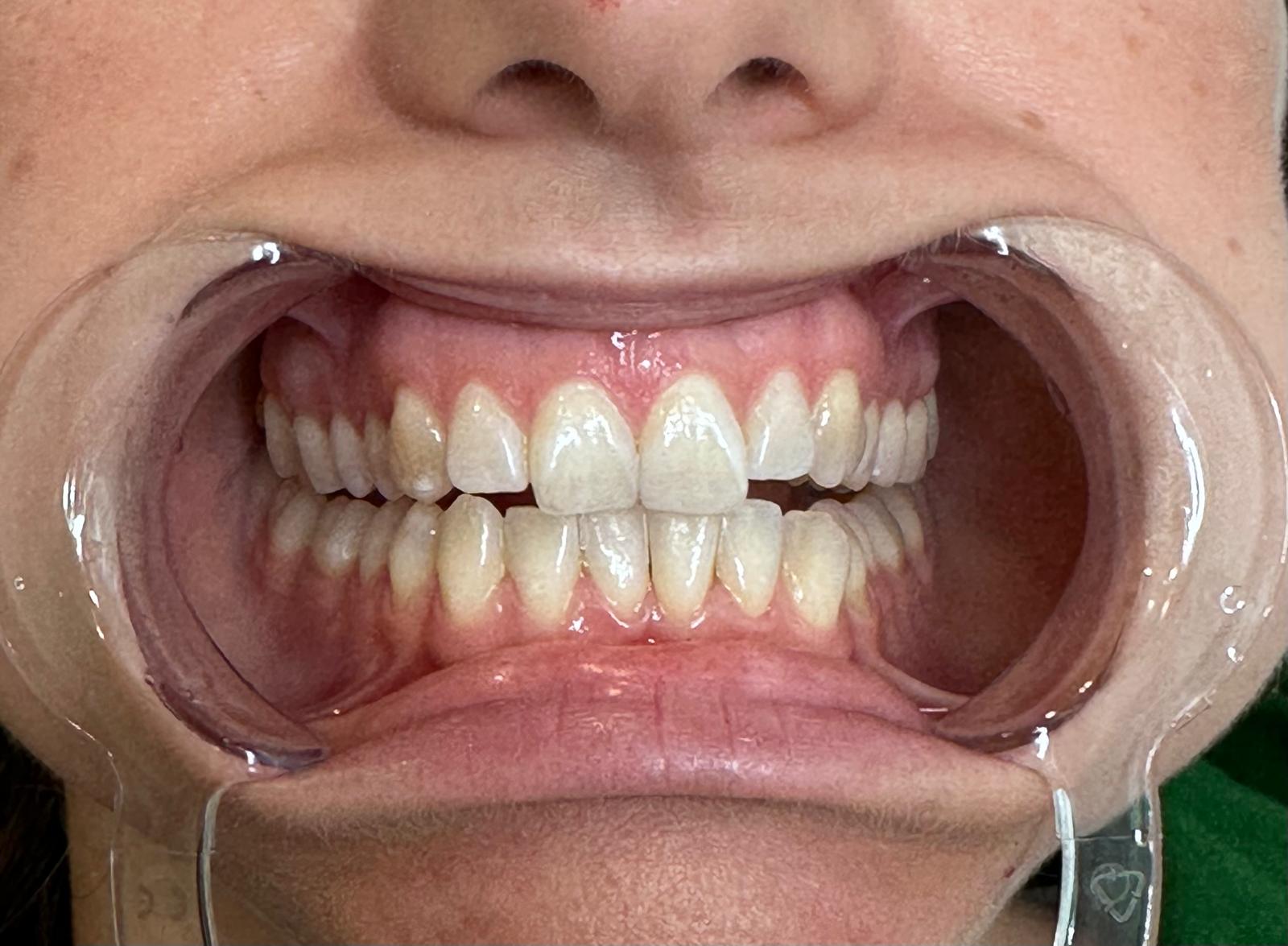 Cosmetic Teeth Whitening Treatment