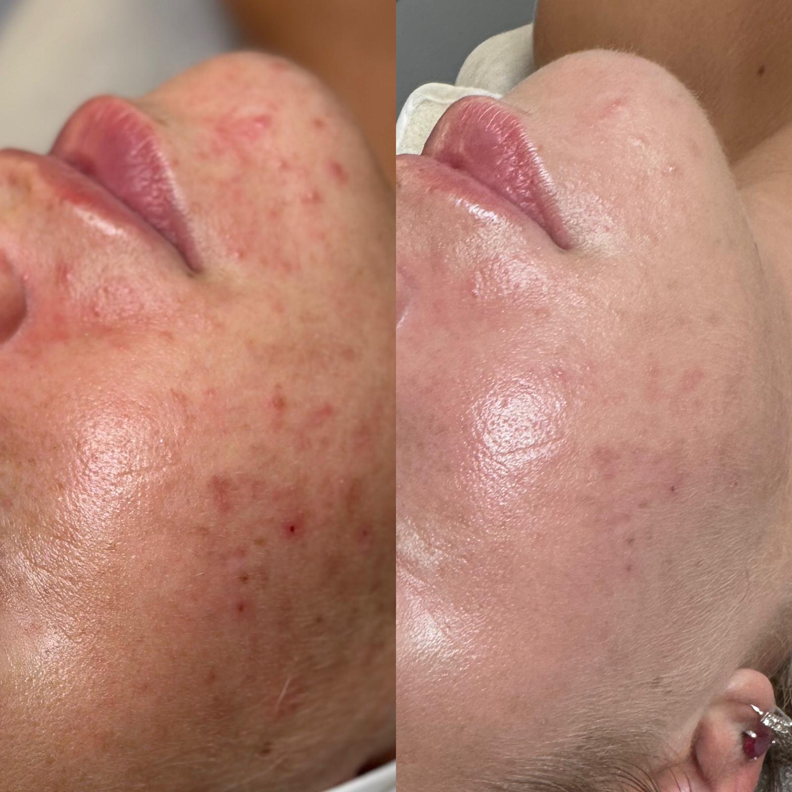 Before and after comparison of skin on a person's face