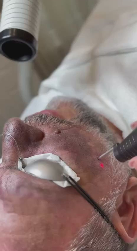 Men's Hollywood Laser Peel