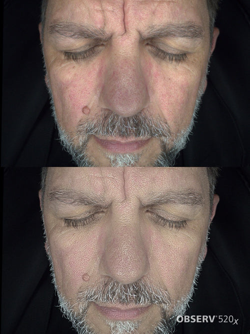 Men's Skin Analysis & Treatment