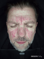 Men's Skin Analysis & Treatment