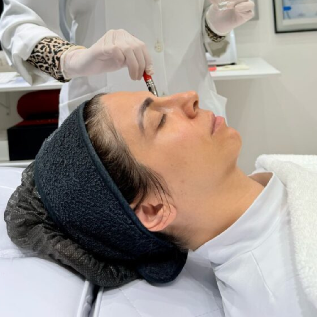 Glycolic Chemical Peel