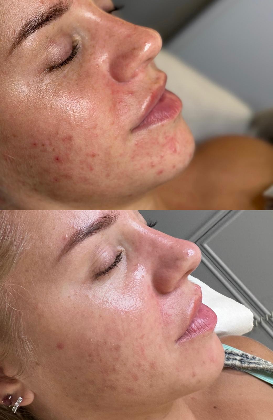 Before and after comparison of a woman's face with acne treatment.
