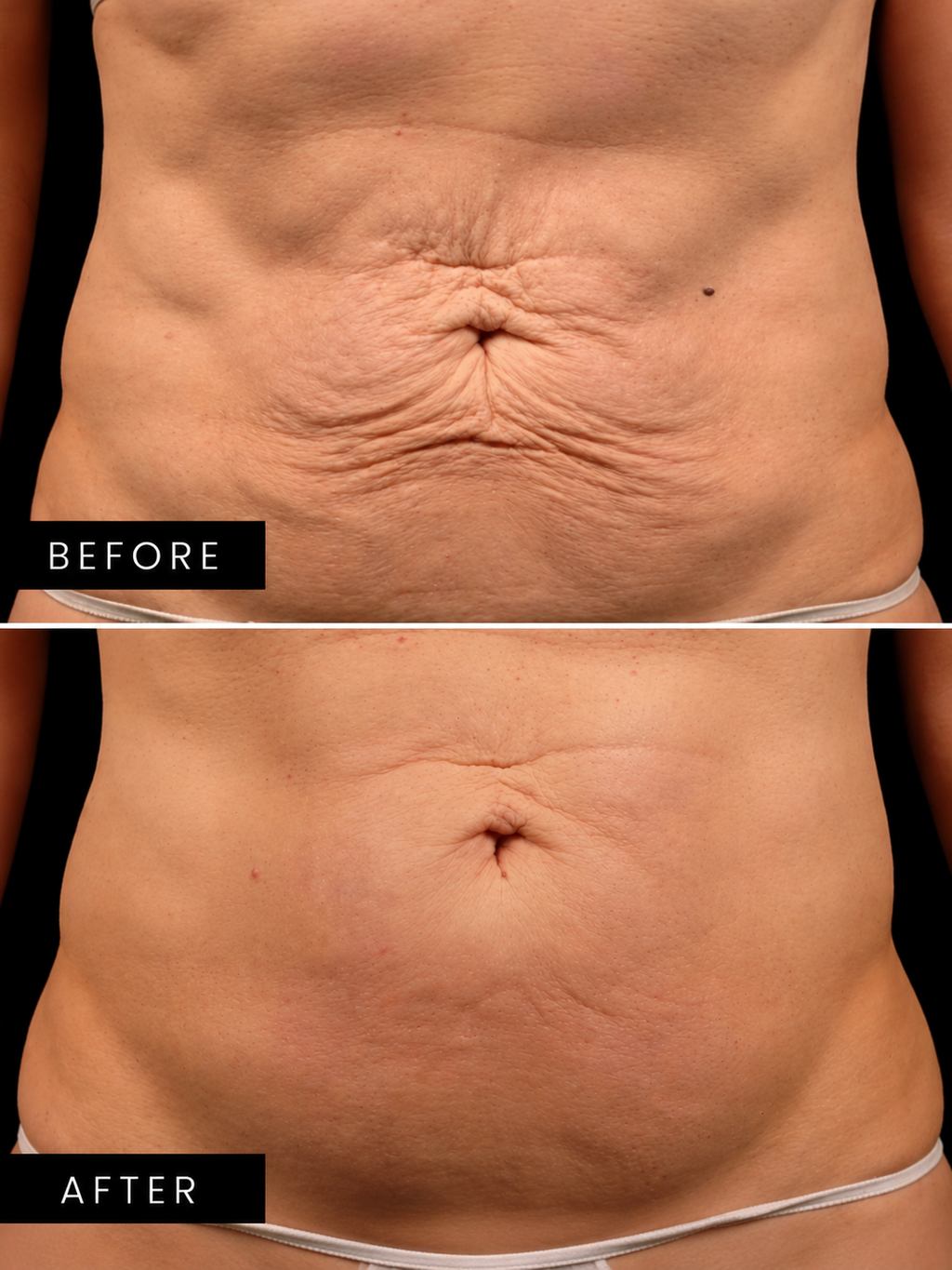 TITANIUM HIFU 3 in 1 - Abdomen