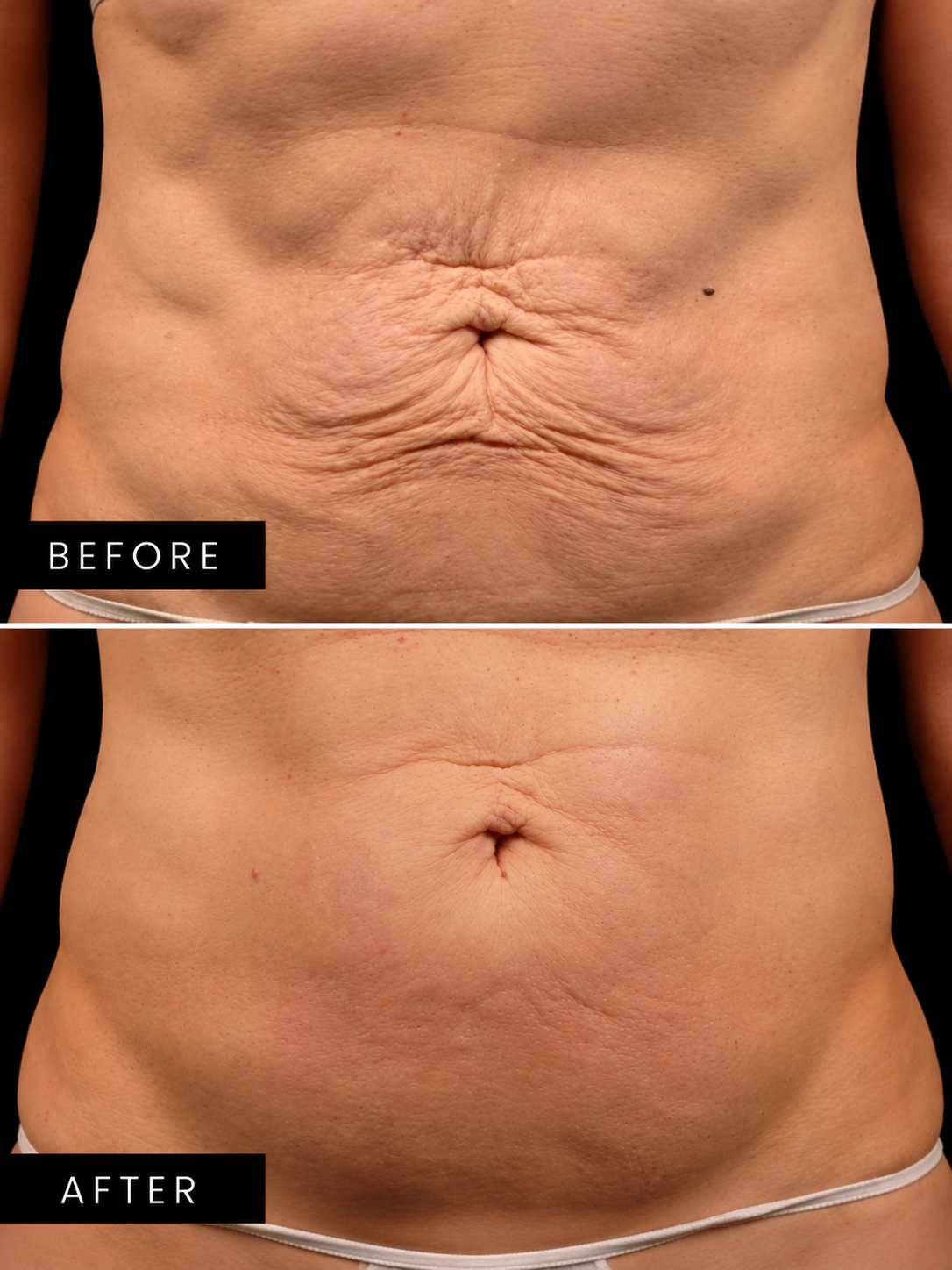 TITANIUM HIFU 3 in 1 - Abdomen