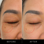 TITANIUM HIFU 3 in 1 - Eyes