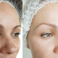 Chemical A-Peel