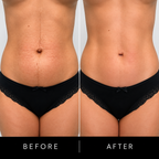 TITANIUM HIFU 3 in 1 - Abdomen