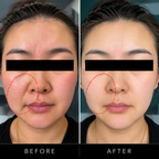 TITANIUM HIFU 3 in 1 - Cheeks