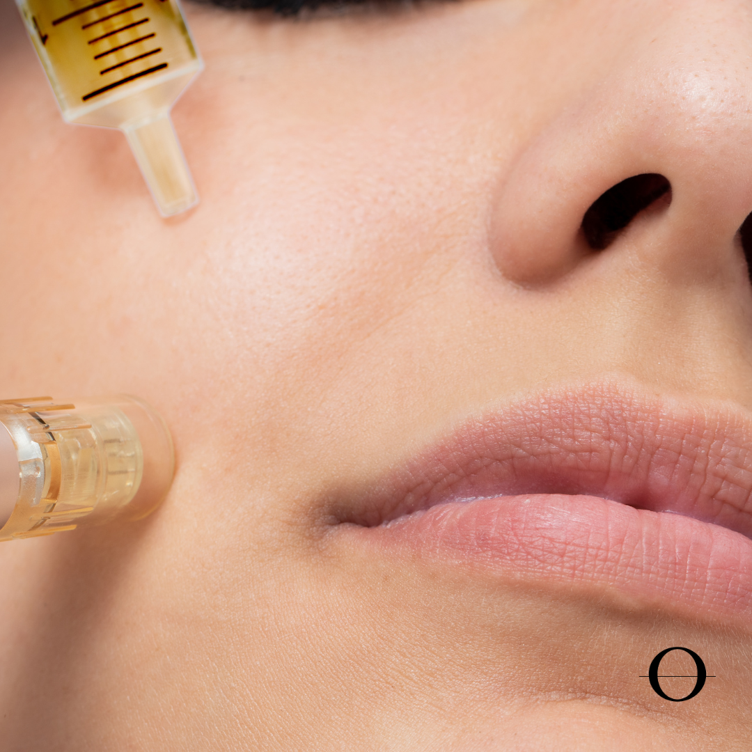 Exosome Iontophoresis Add-On