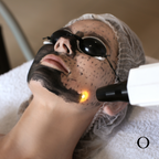 Hollywood Express Laser Peel / Carbon Peel