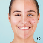 Hollywood Express Laser Peel / Carbon Peel