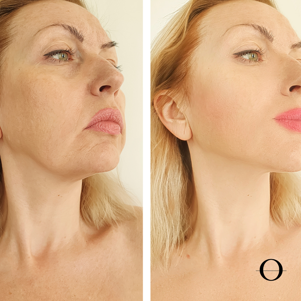 Hollywood Laser Soft Peel