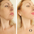 Hollywood Laser Soft Peel