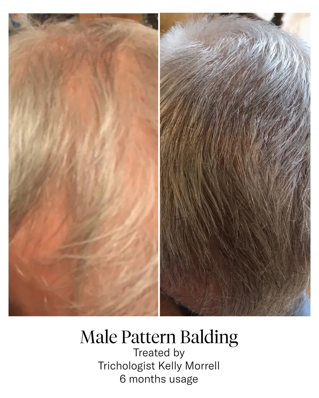Calecim Professional Advanced Hair System