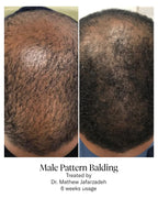 Calecim Professional Advanced Hair System
