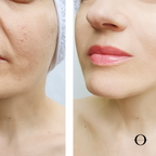 LED LDM RF Tightening Facial