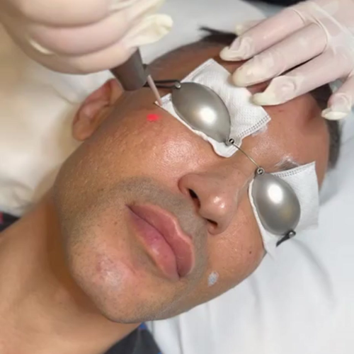 Men's Hollywood Laser Toning
