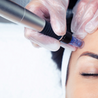 Nano Microneedling