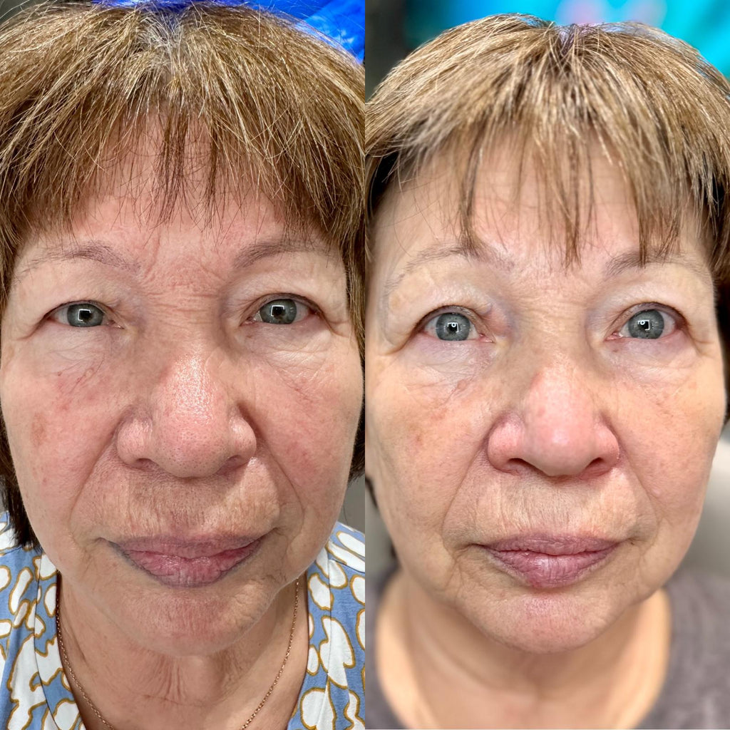 Before and after comparison of a woman's face with visible aging signs.