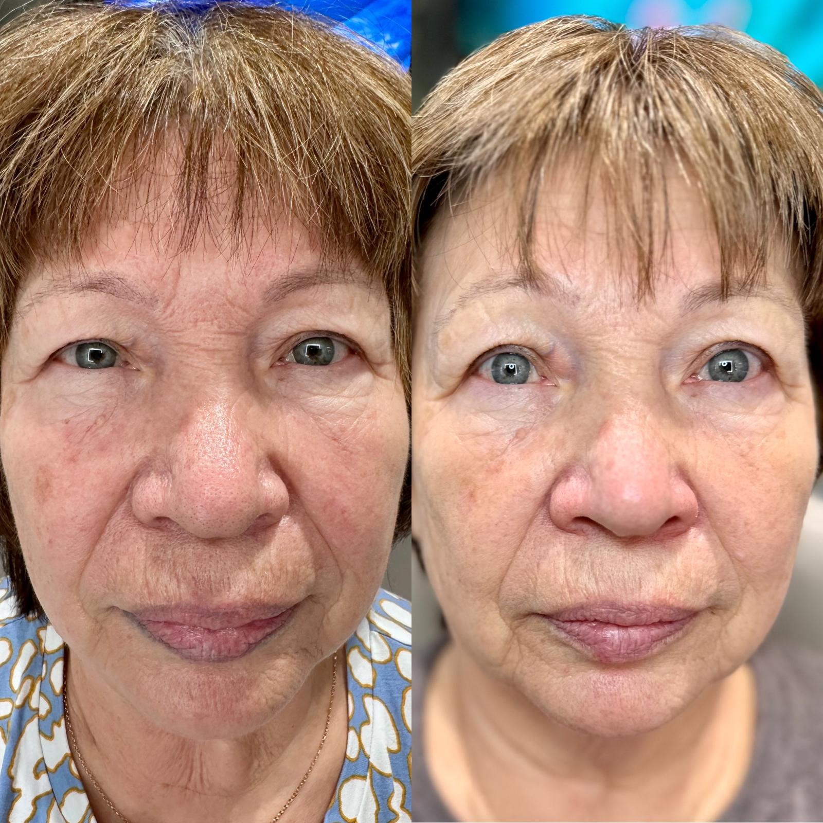 Before and after comparison of a woman's face with visible aging signs.