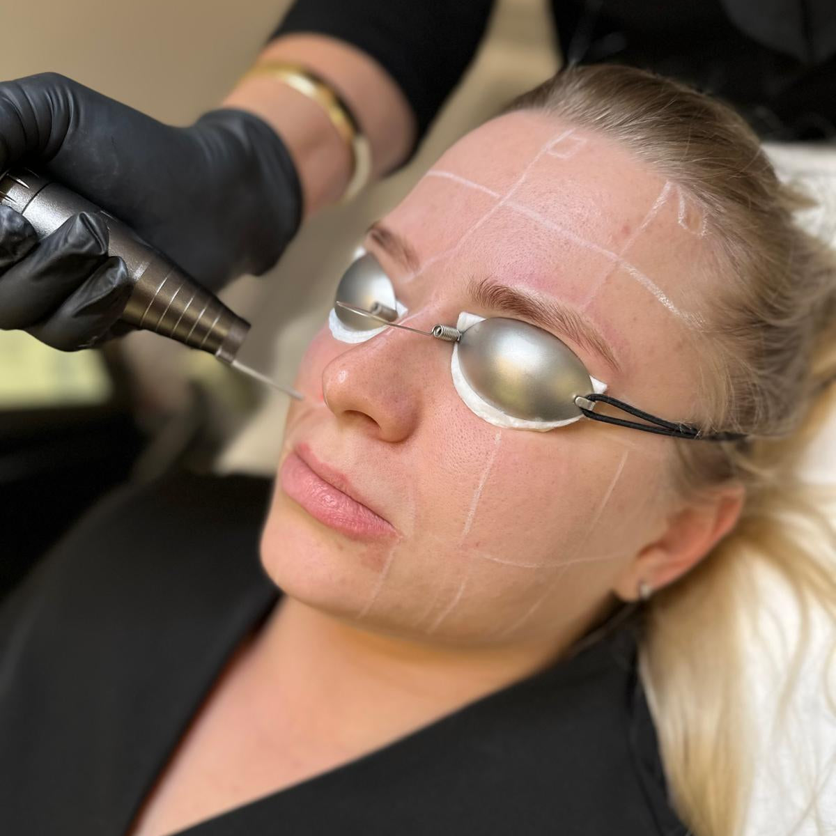 Person receiving a cosmetic procedure with protective goggles on.