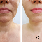 Seoul Radiance Laser