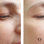 Snow Silk Collagen Facial