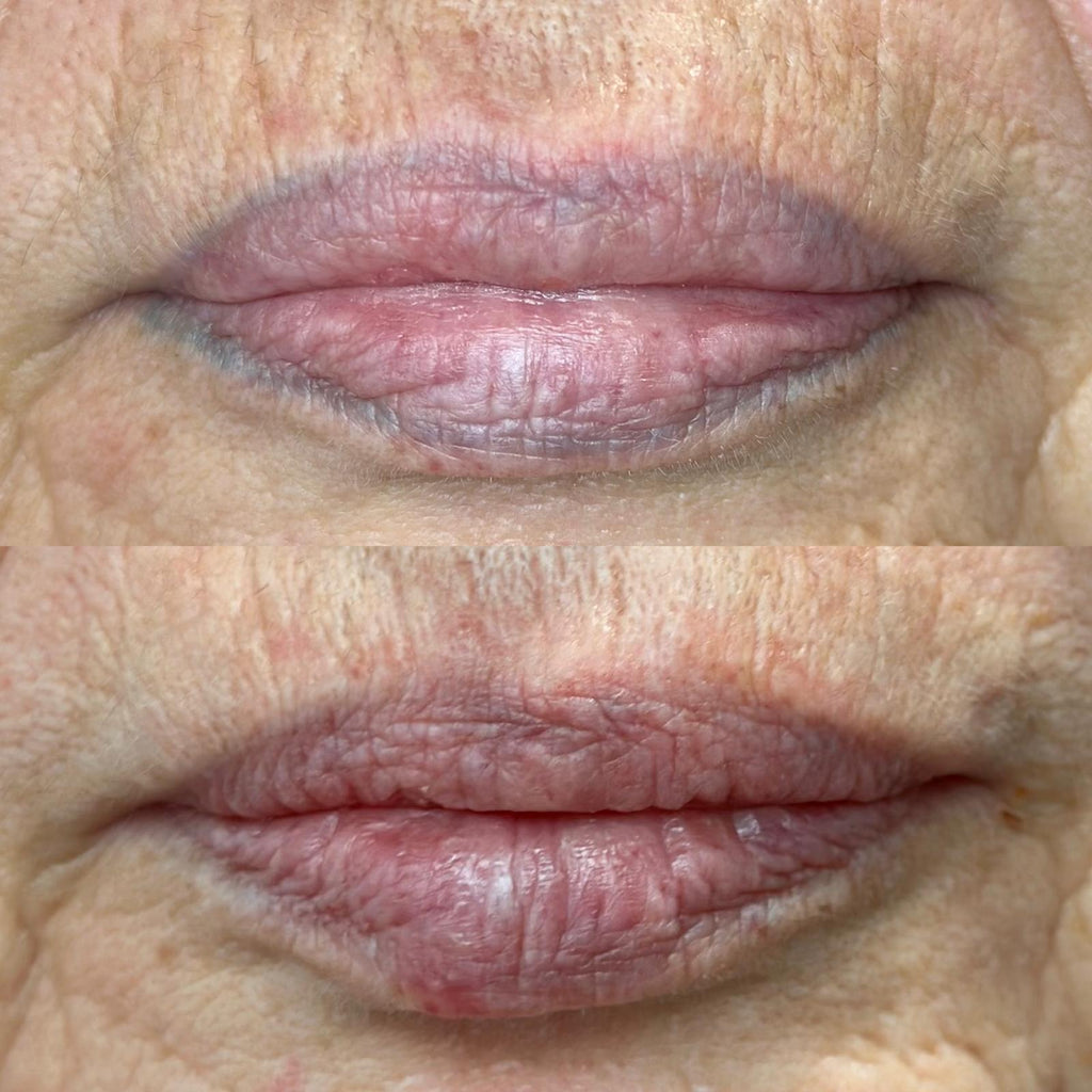 lips before and after cosmetic tattoo removal with laser