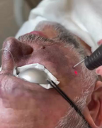 Close-up of a person using a laser device on their face.