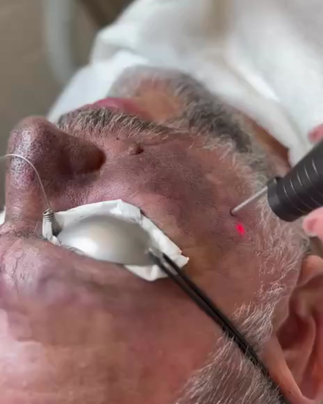 Close-up of a person using a laser device on their face.