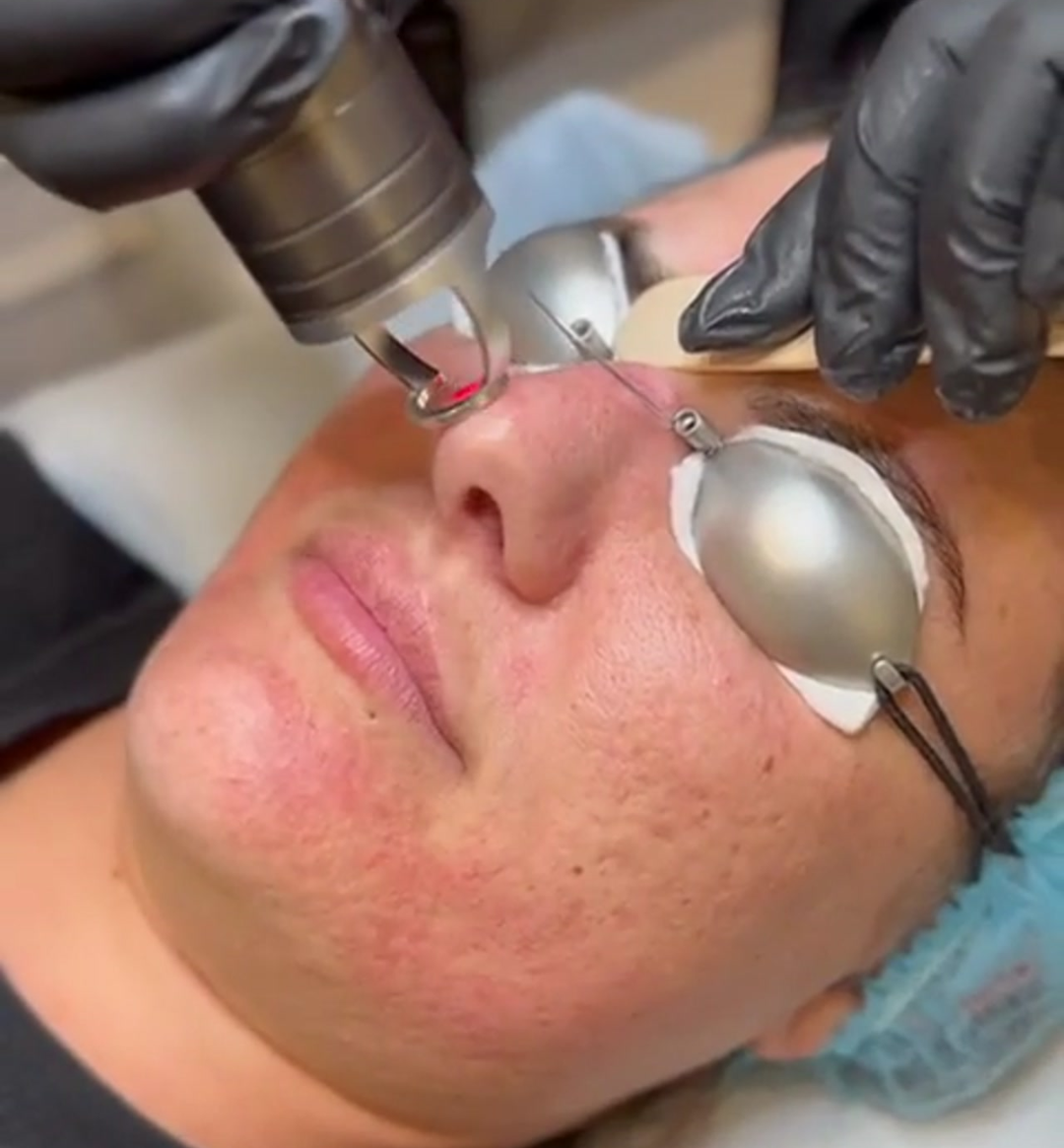 Person receiving a cosmetic procedure with medical equipment on a white background